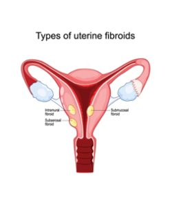 Fibroids
